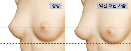 유방하수 정도