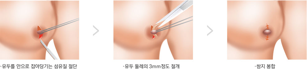 保留乳腺管法