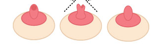 无法哺乳的不保留乳腺管法