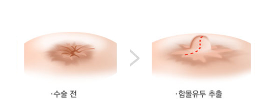 不保留乳腺管法