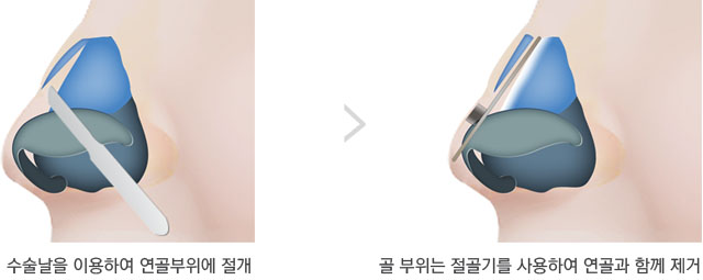 매부리코성형