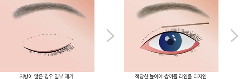 쌍꺼풀
