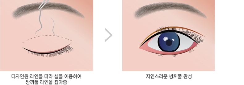 쌍꺼풀