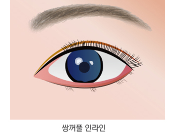 쌍꺼풀 종류
