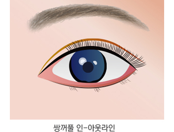 쌍꺼풀 종류