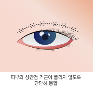 쌍꺼풀 2단계