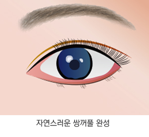 쌍꺼풀 3단계