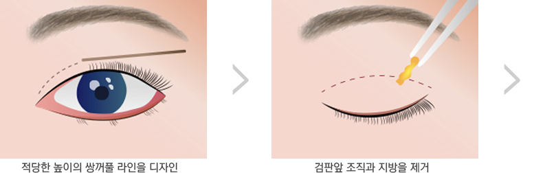 쌍꺼풀
