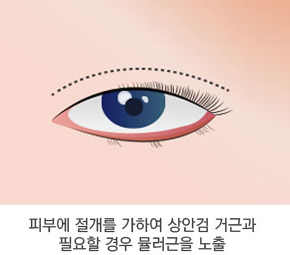 절개 눈매교정술 수술방법 1단계