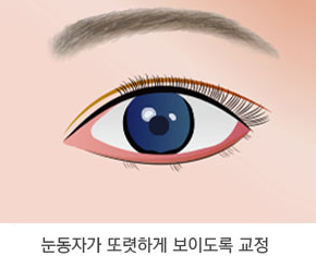 절개 눈매교정술 수술방법 3단계