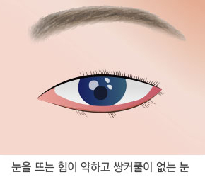 눈매교정술 1단계