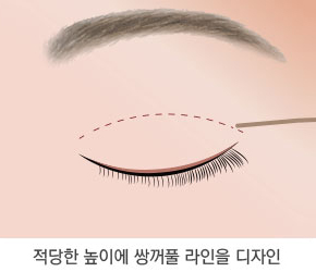 눈매교정술 2단계