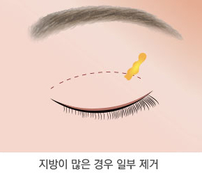 눈매교정술 3단계