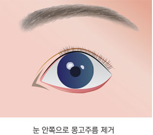 일반적인 앞트임 수술법 1단계