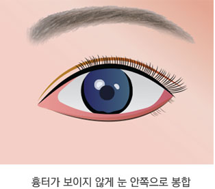 일반적인 앞트임 수술법 3단계