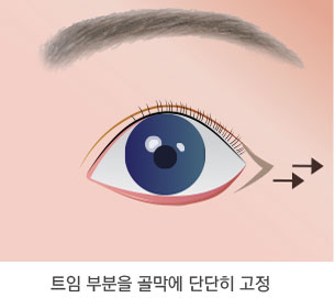 뒷트임 수술방법 2단계