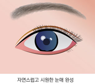 뒷트임 수술방법 3단계