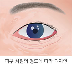 눈밑 지방이 불룩하고 피부가 처진 경우 1단계
