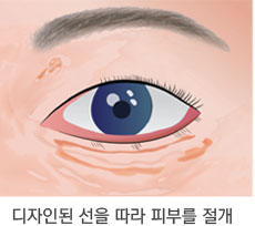 눈밑 지방이 불룩하고 피부가 처진 경우 2단계