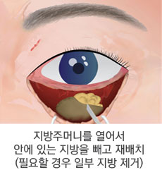 눈밑 지방이 불룩하고 피부가 처진 경우 4단계