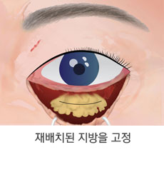눈밑 지방이 불룩하고 피부가 처진 경우 5단계