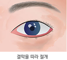 피부 처짐이 거의 없이 지방만 볼록한 경우 1단계